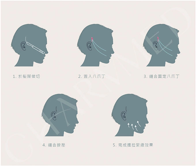 誠美學診所中下臉拉皮療程手術