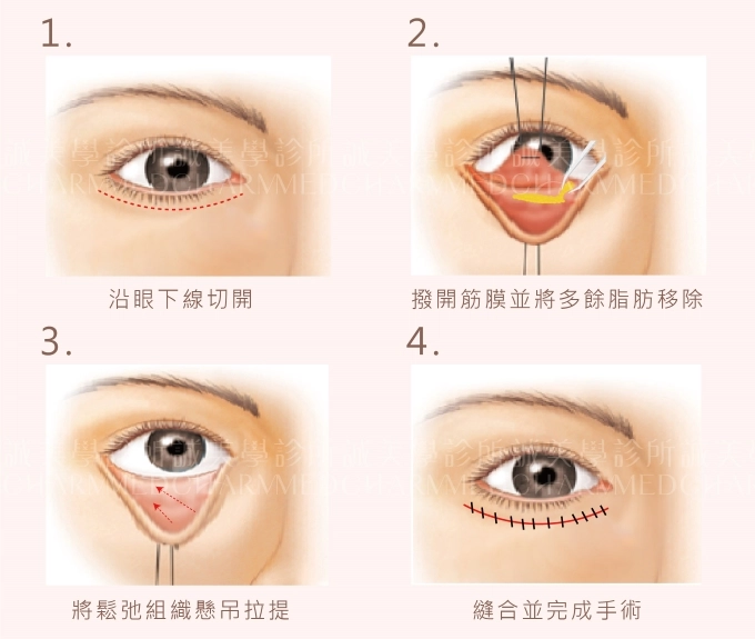誠美學診所眼袋外開療程介紹