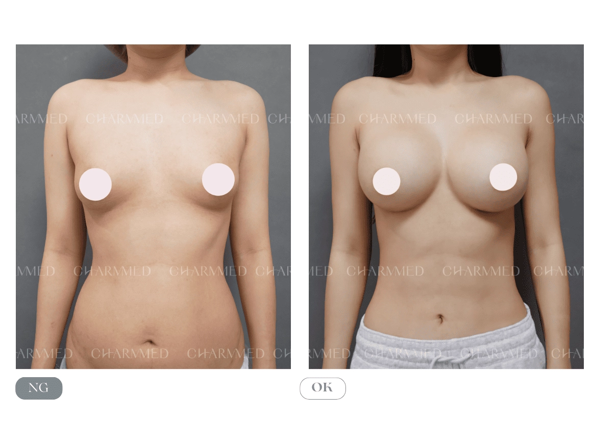 誠美學診所隆乳術前術後
