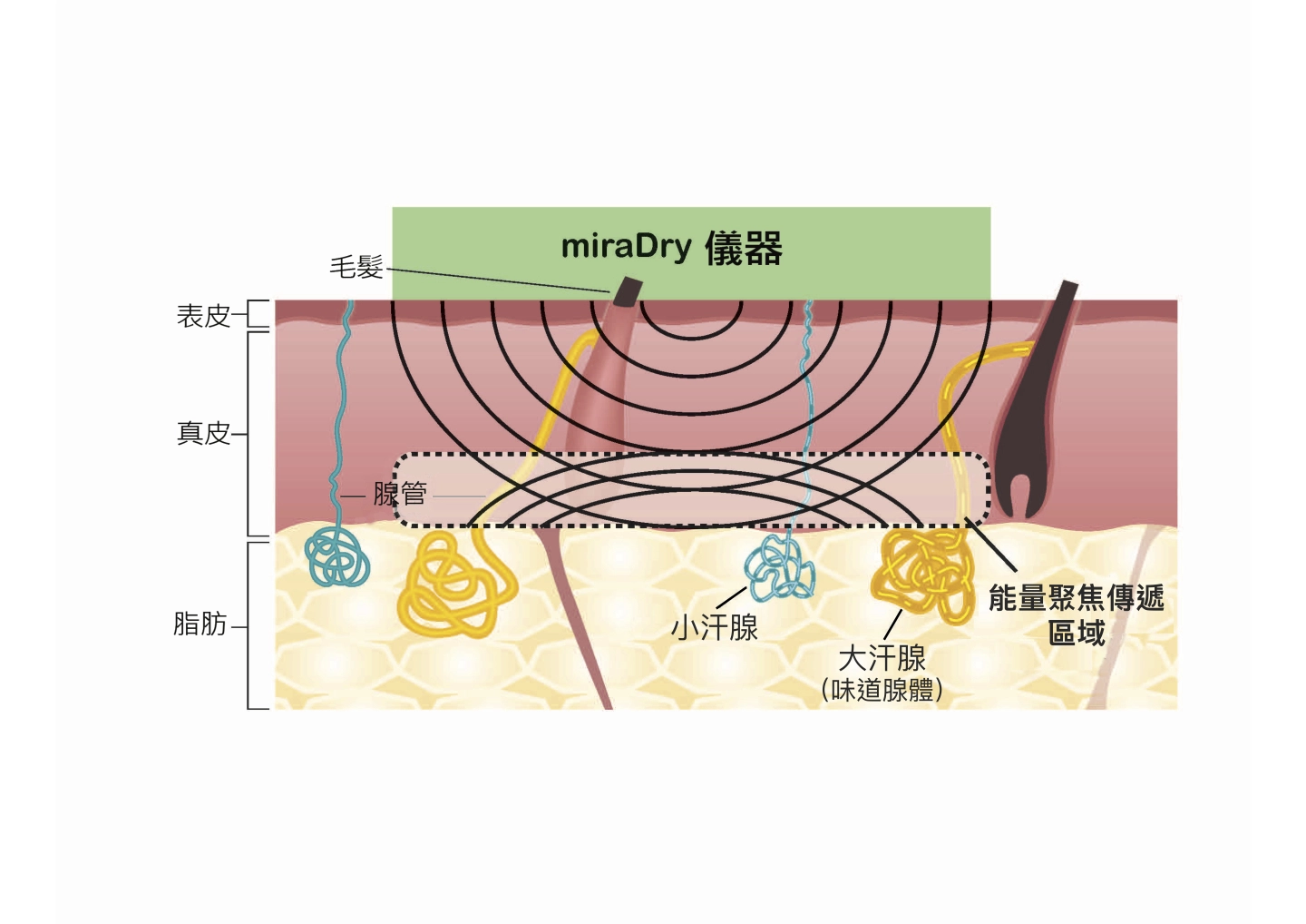 誠美學診所miraDry清新微波療程儀器