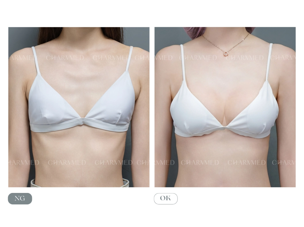 誠美學診所魔滴自然系隆乳效果對比