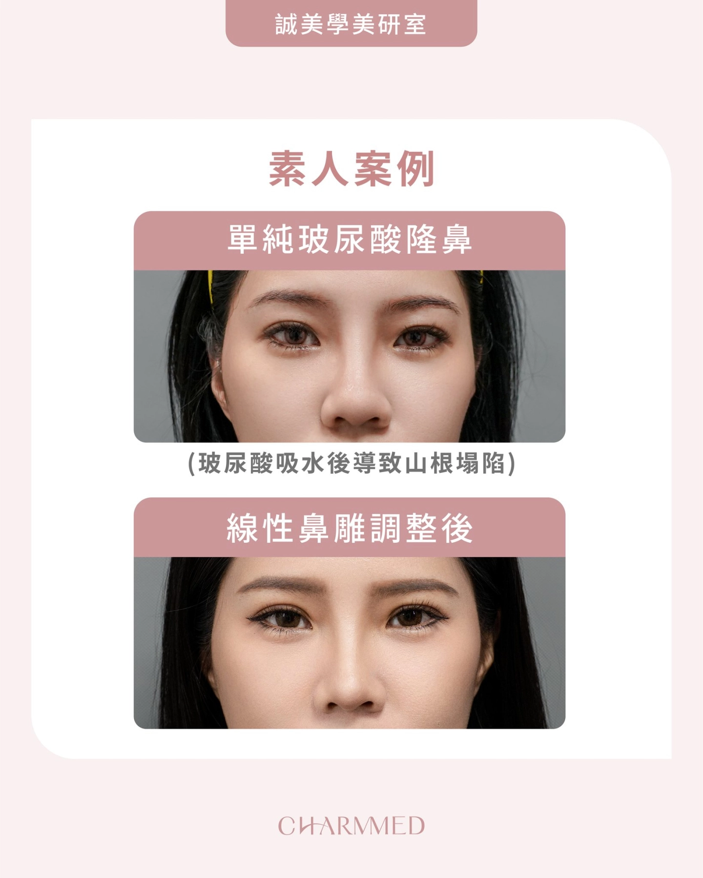 玻尿酸隆鼻+線性鼻雕誠美學診所範例