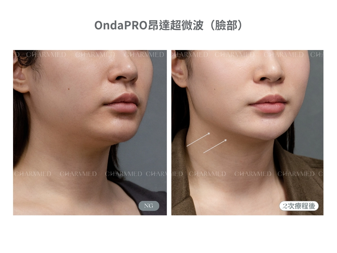 瘦了臉還很泡?問題可能不是胖!Onda PRO雕塑俐落線條