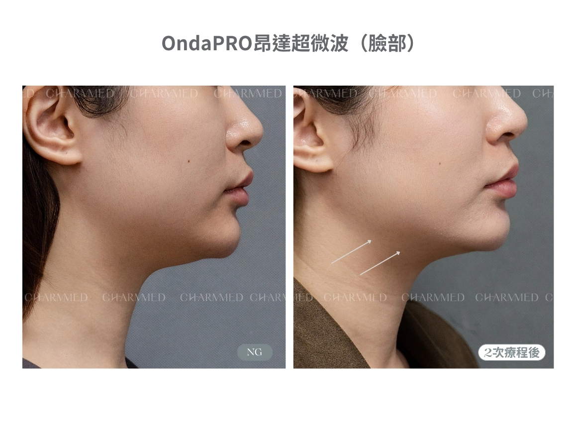 Onda PRO超微波改善雙下巴、泡泡臉!