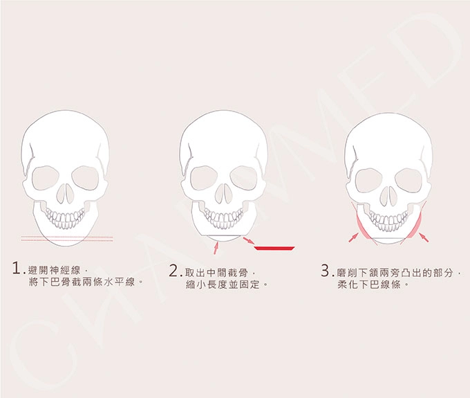 誠美學診所下巴削骨
