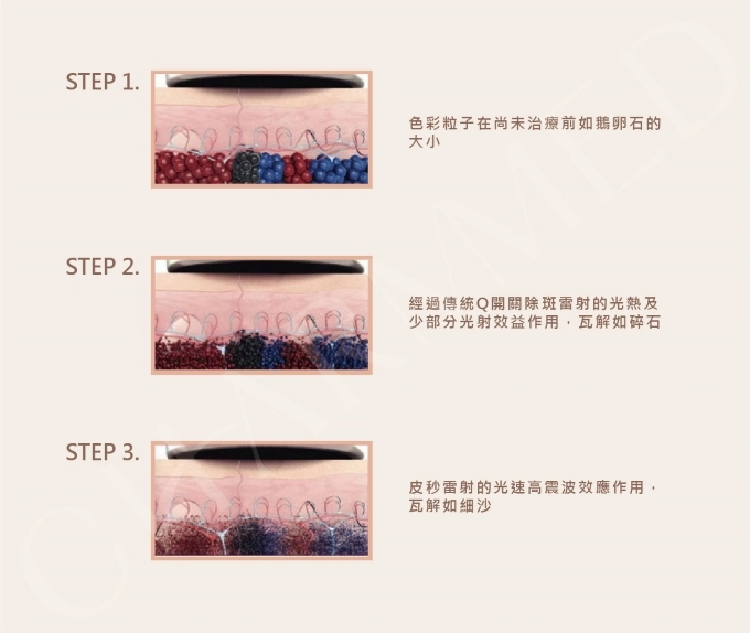 誠美學診所PicoWay超皮秒