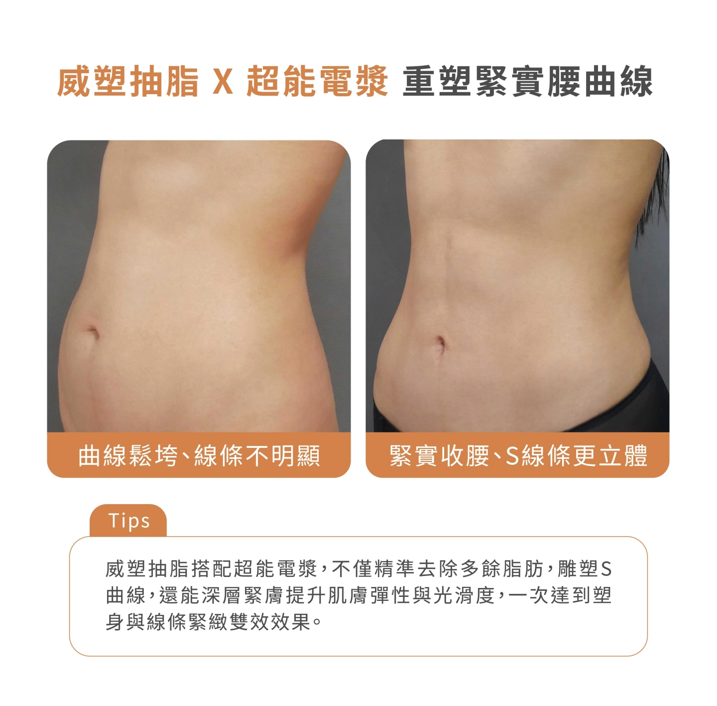 誠美學診所超能電漿X威塑抽脂