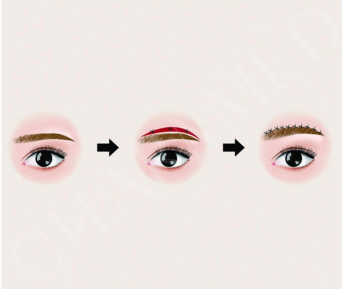 誠美學診所眉上切提眉