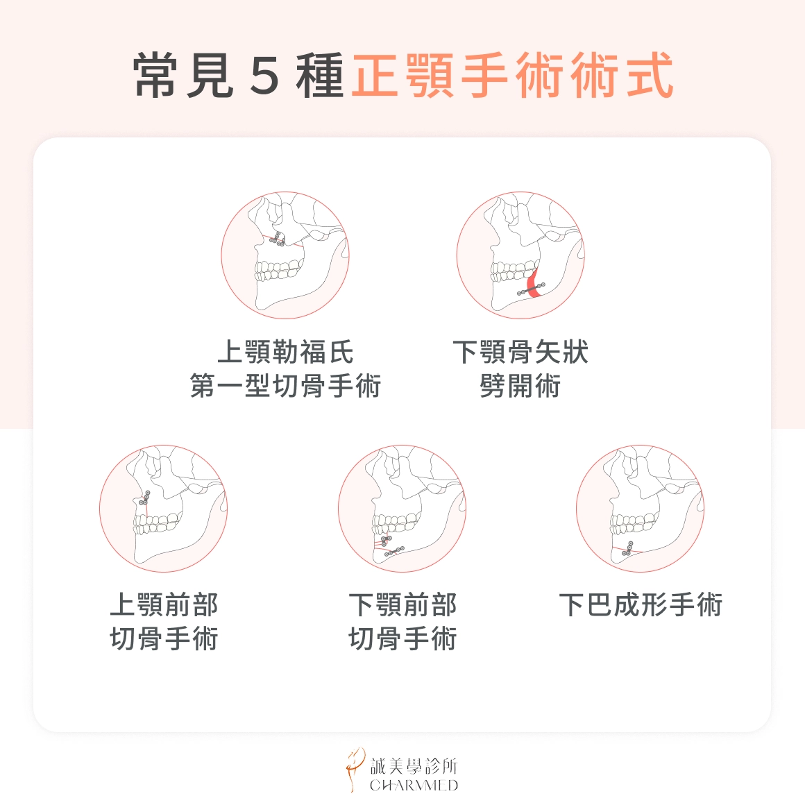 常見 5 種正顎手術術式