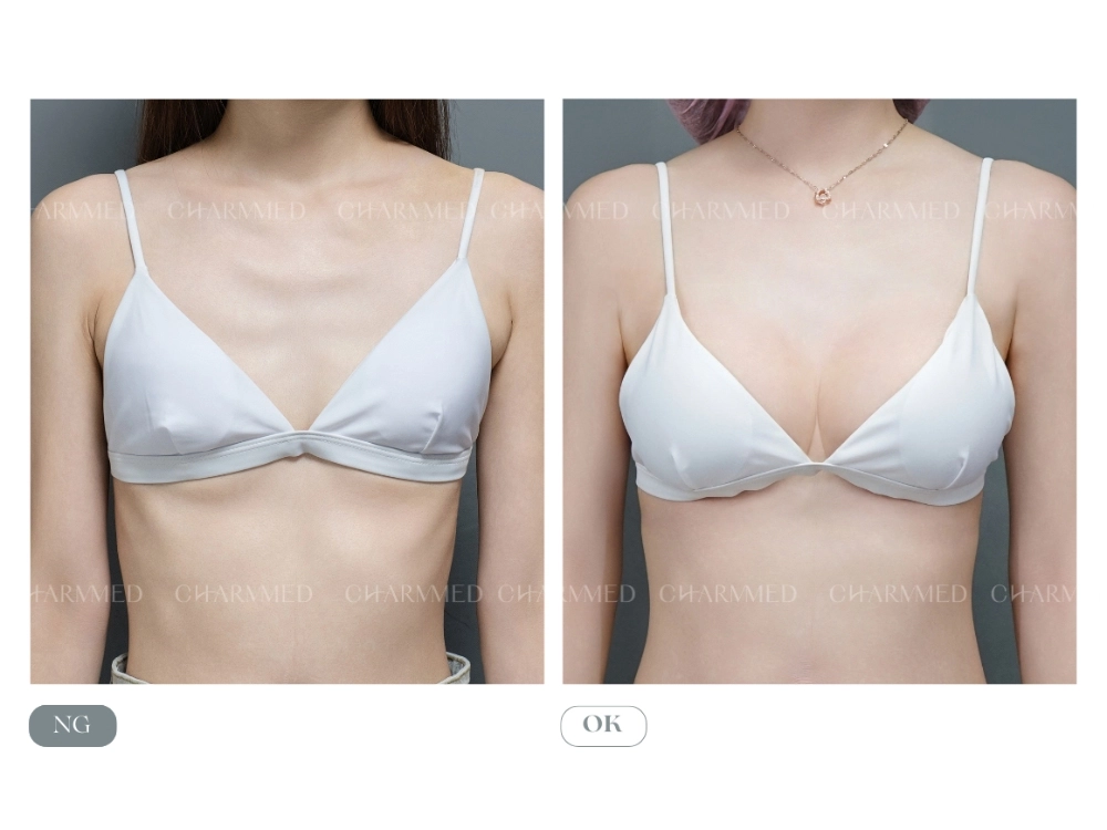【誠美學診所】的隆乳美麗見證