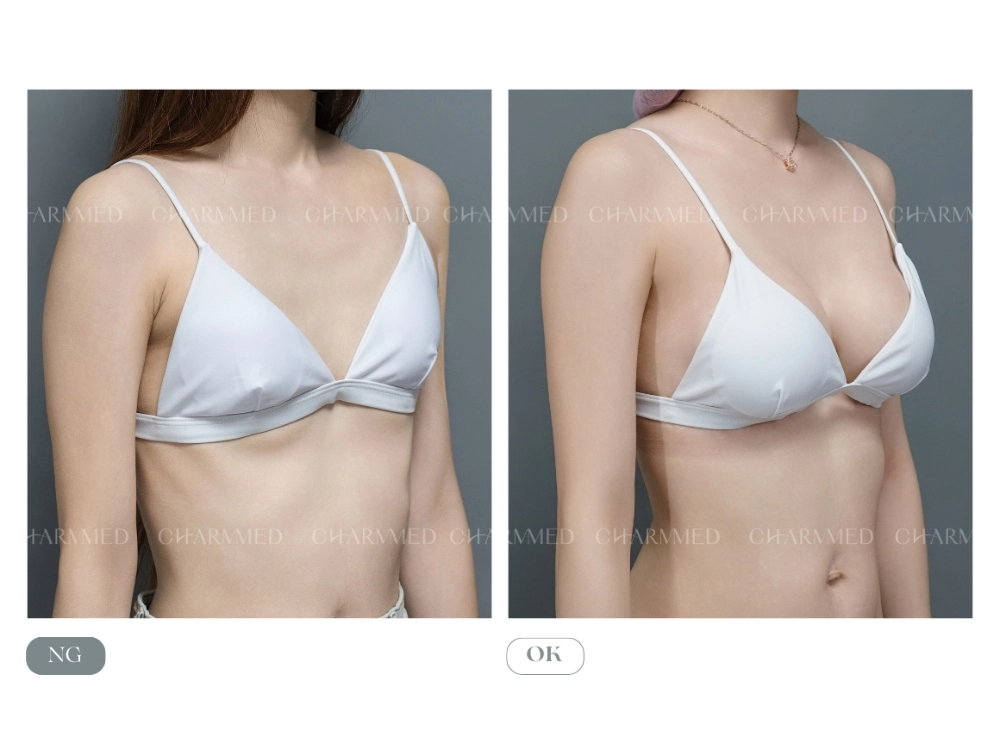 【誠美學診所】的隆乳美麗見證