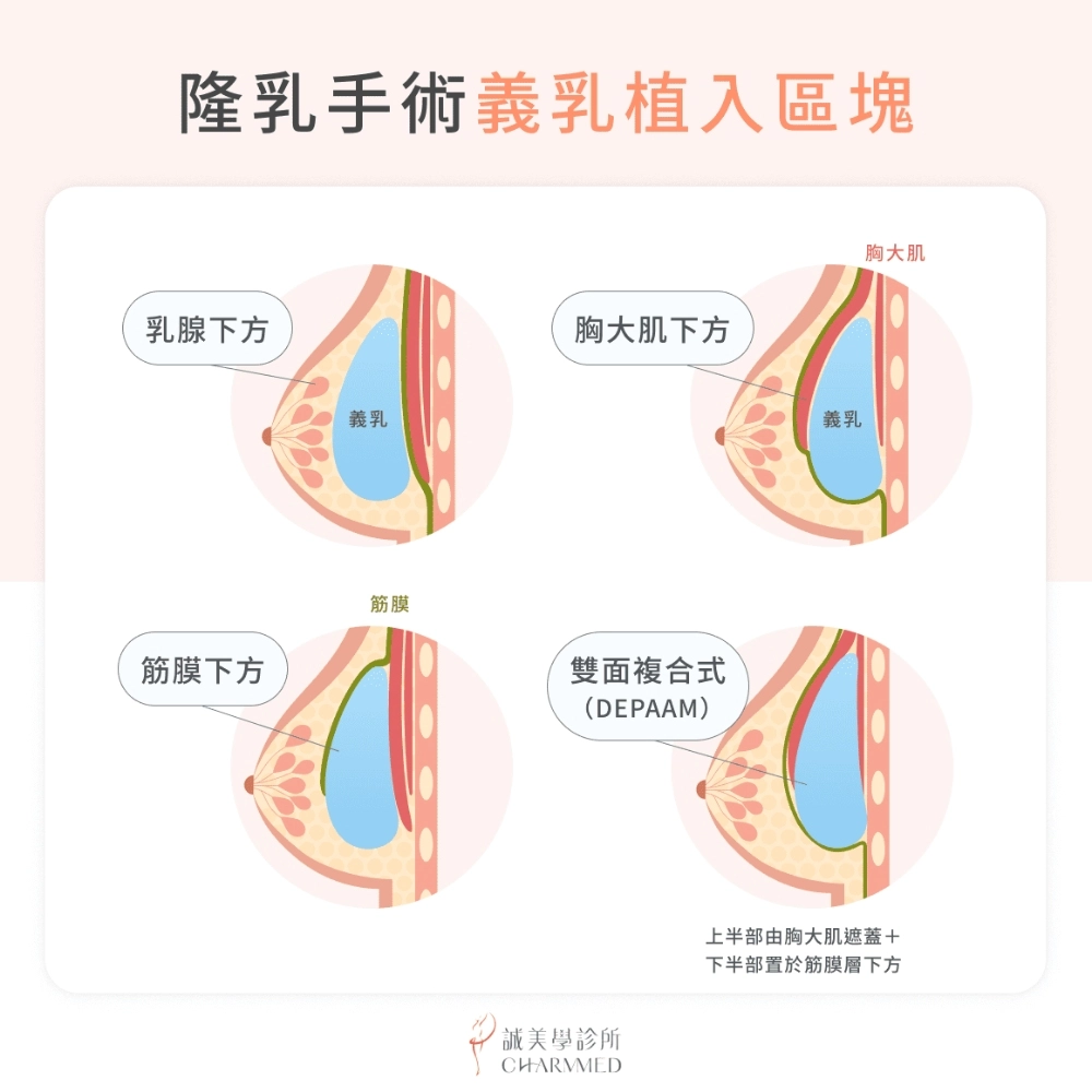 隆乳手術義乳植入區塊