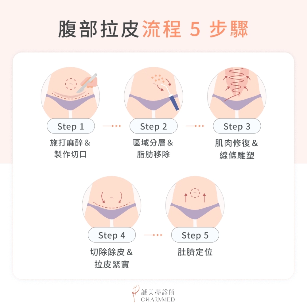 腹部拉皮手術流程 5 步驟