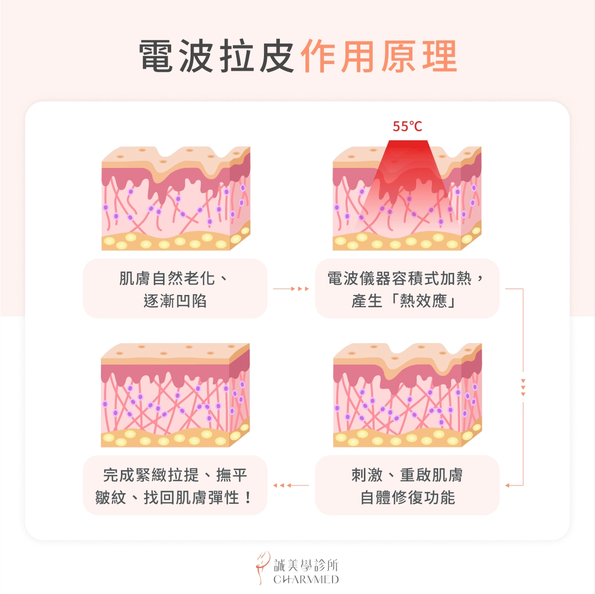 電波拉皮作用原理