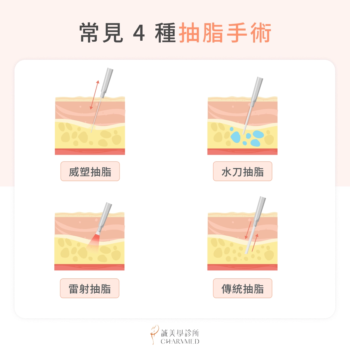 常見 4 種抽脂手術