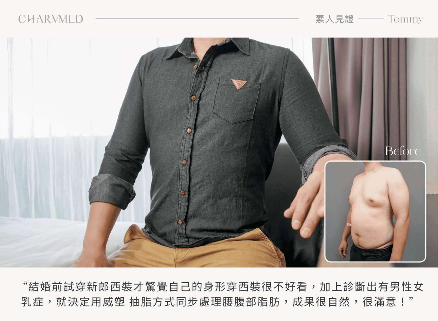 抽脂案例 3|男性也能抽脂!告別鬆垮,找回緊實體態