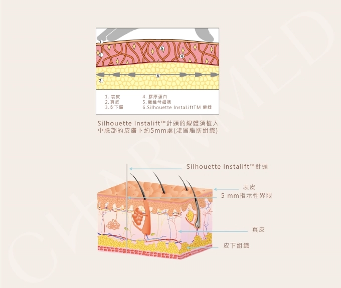 誠美學診所塑立愛立提線療程介紹