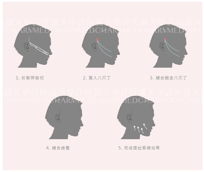 誠美學診所中下臉拉皮手術八爪拉皮