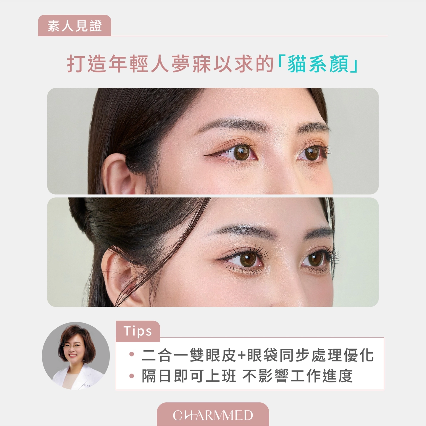 台中誠美學 蔡青穎醫師【五合一隱痕眼袋+縫雙眼皮】案例