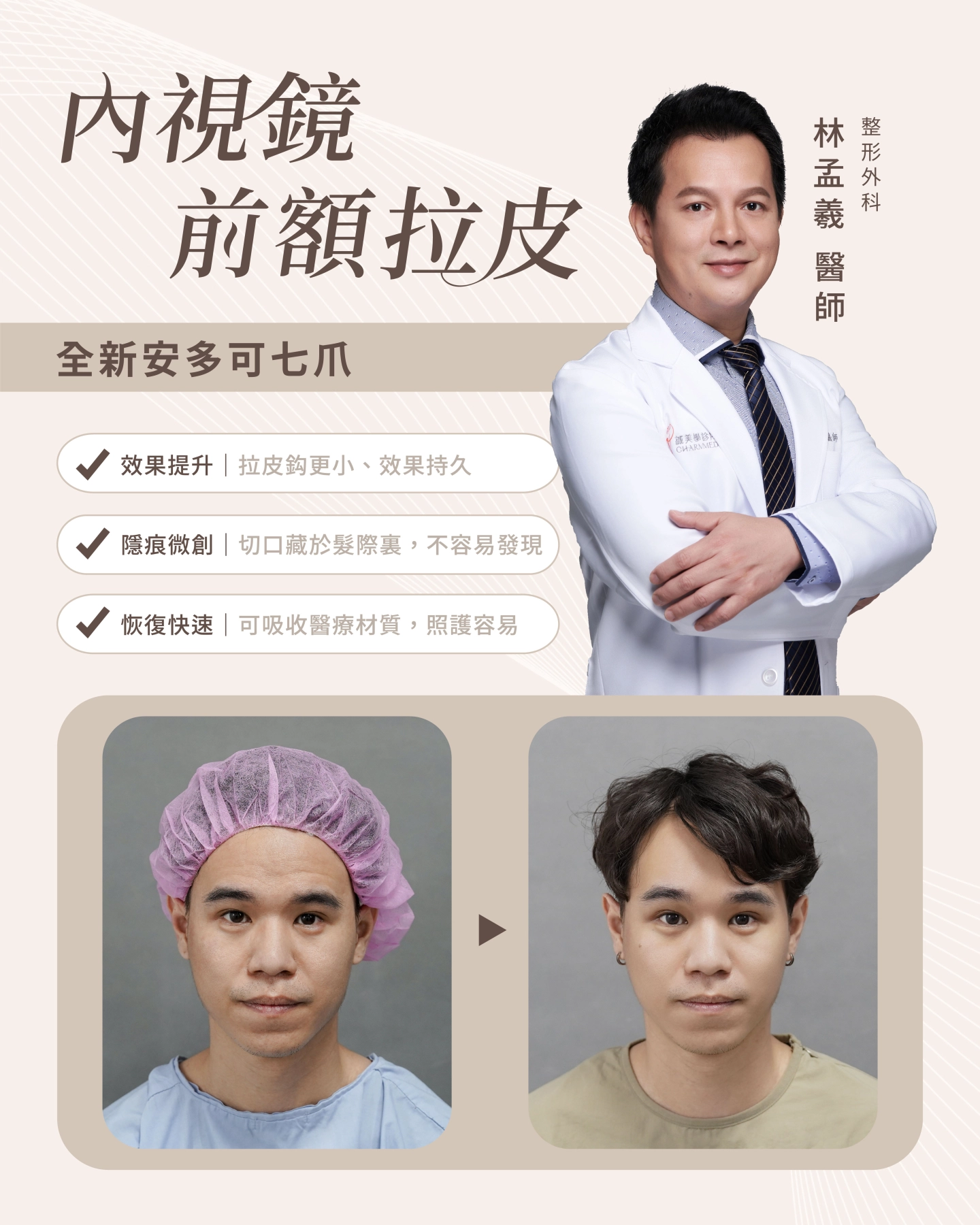 台中 誠美學診所 院長林孟羲醫師 内視鏡前額拉皮-安多可七爪拉皮案例作品