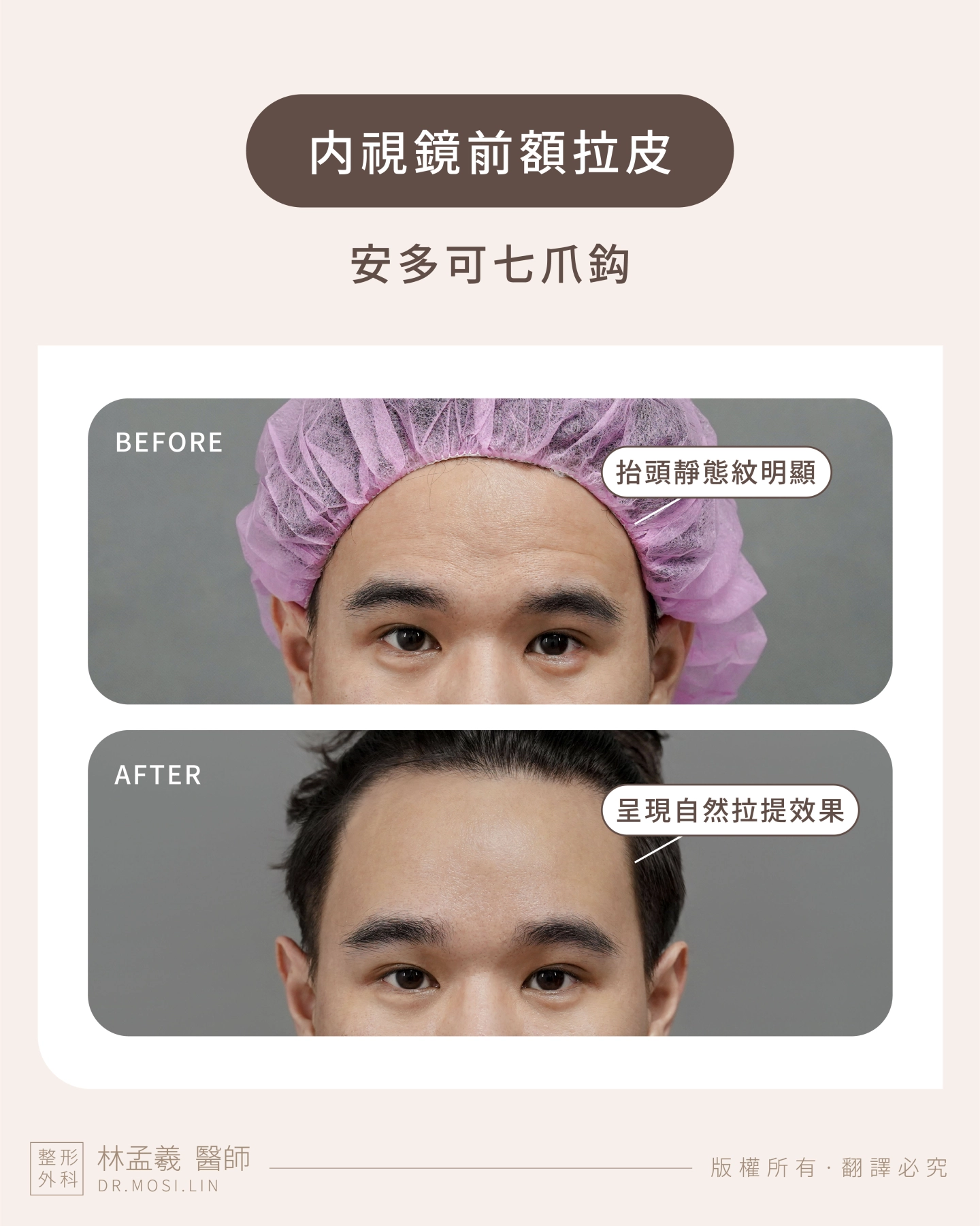 台中 誠美學診所 院長林孟羲醫師 内視鏡前額拉皮-安多可七爪拉皮案例作品-前後對比