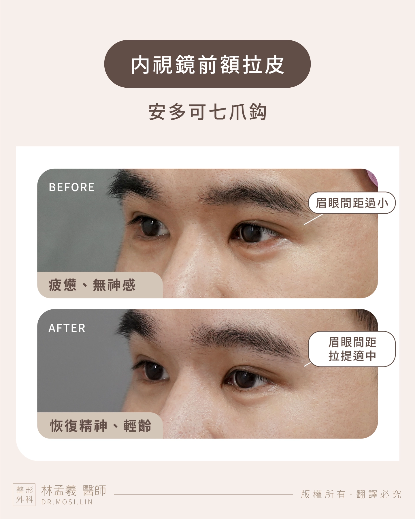 台中 誠美學診所 院長林孟羲醫師 内視鏡前額拉皮-安多可七爪拉皮案例作品-前後對比