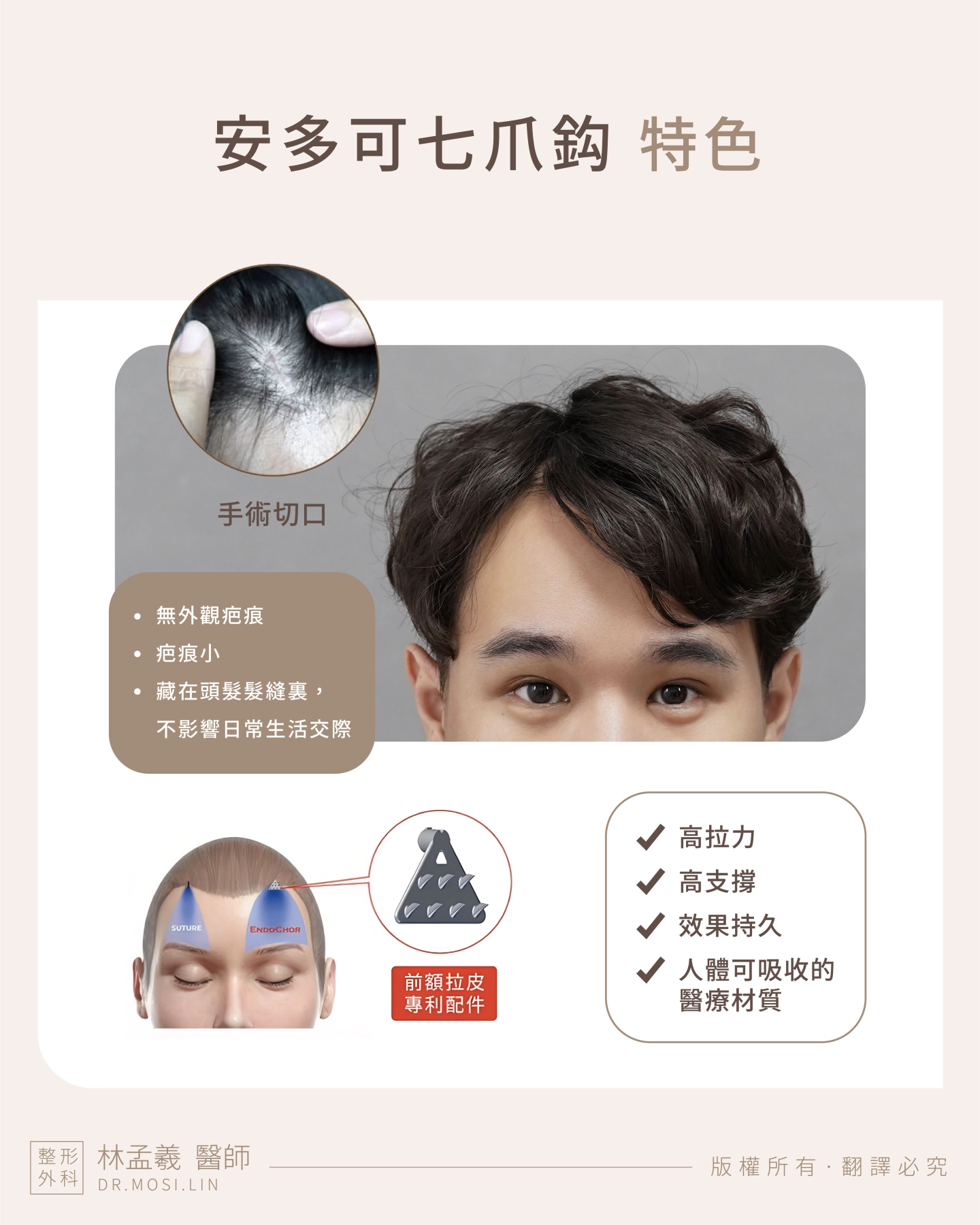 台中 誠美學診所 院長林孟羲醫師 内視鏡前額拉皮-安多可七爪拉皮疤痕隱藏及維持度