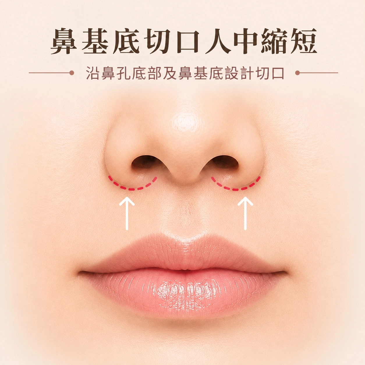 鼻基底切口人中縮短