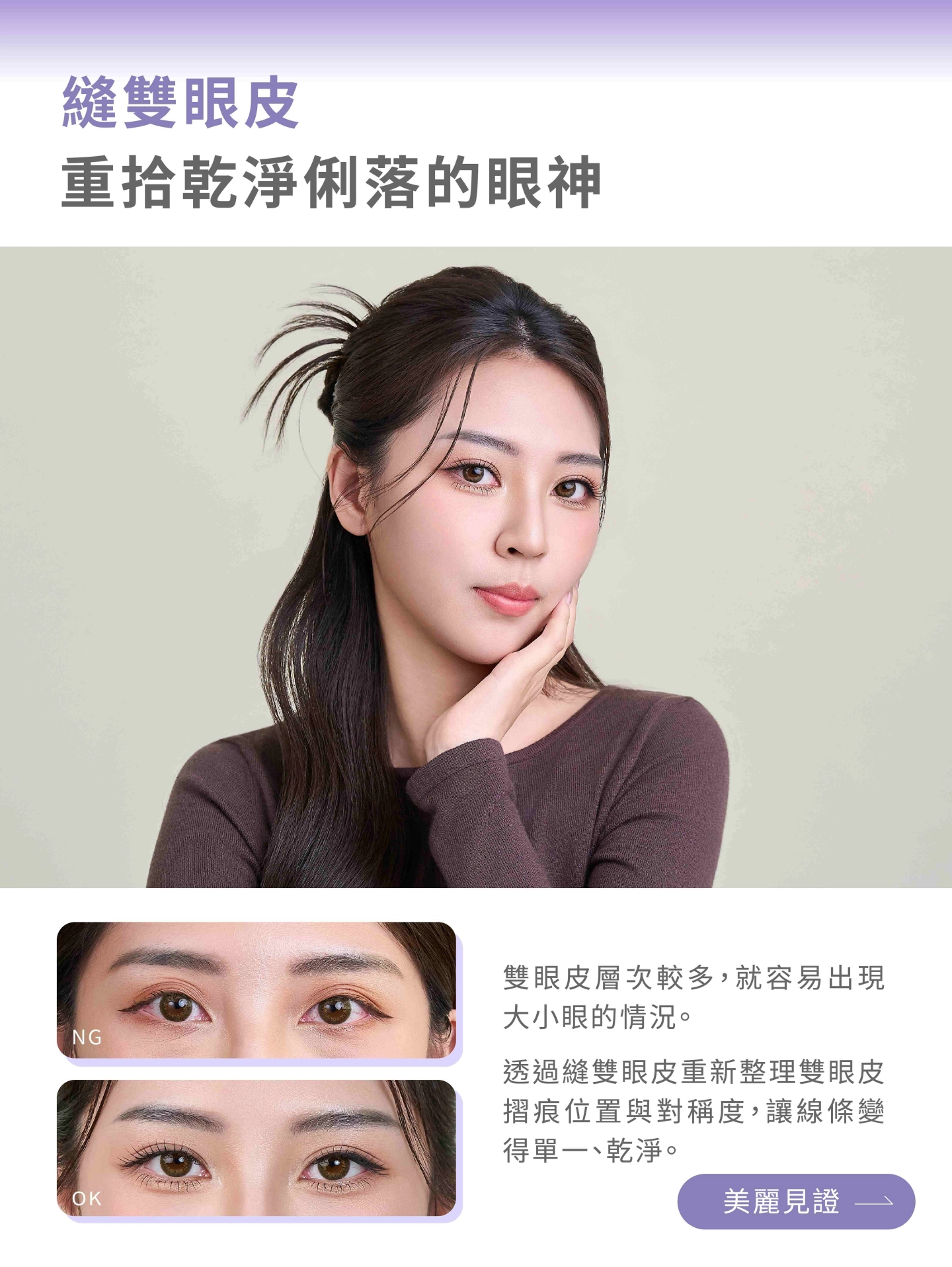 誠美學縫雙眼皮美麗見證