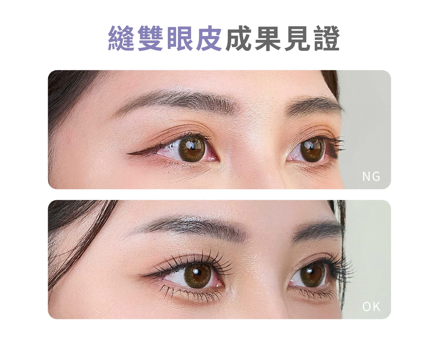 誠美學縫雙眼皮成果見證