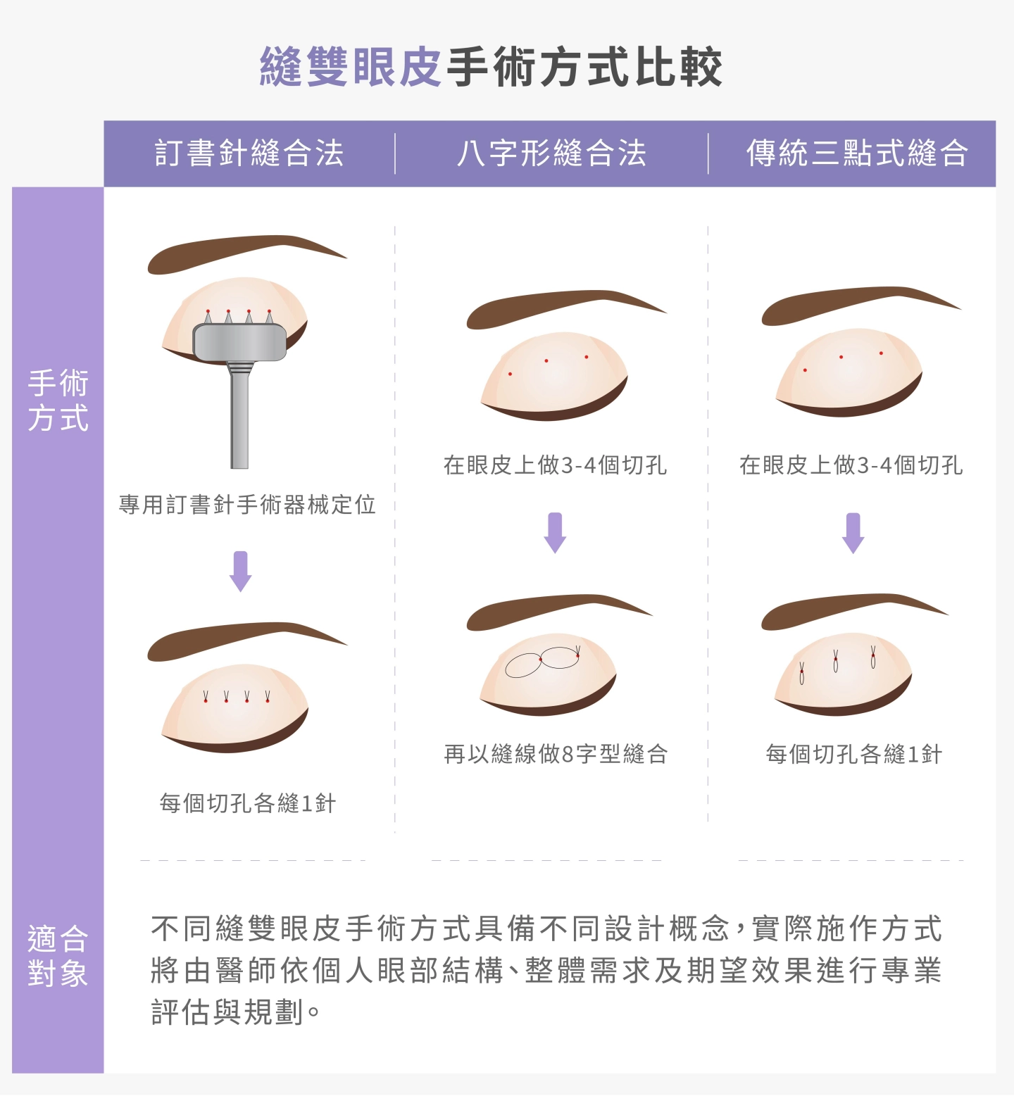 誠美學縫雙眼皮手術方法比較