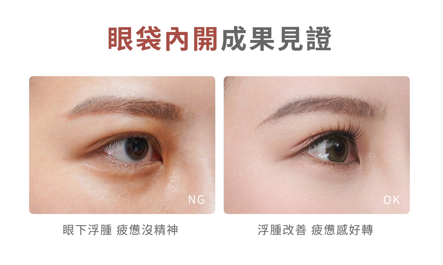 誠美學診所眼袋內開成果