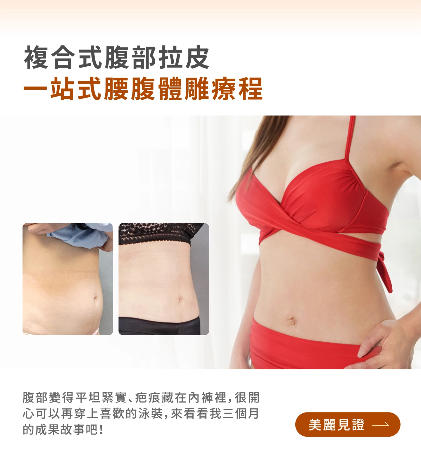 誠美學診所腹部拉皮真實案例