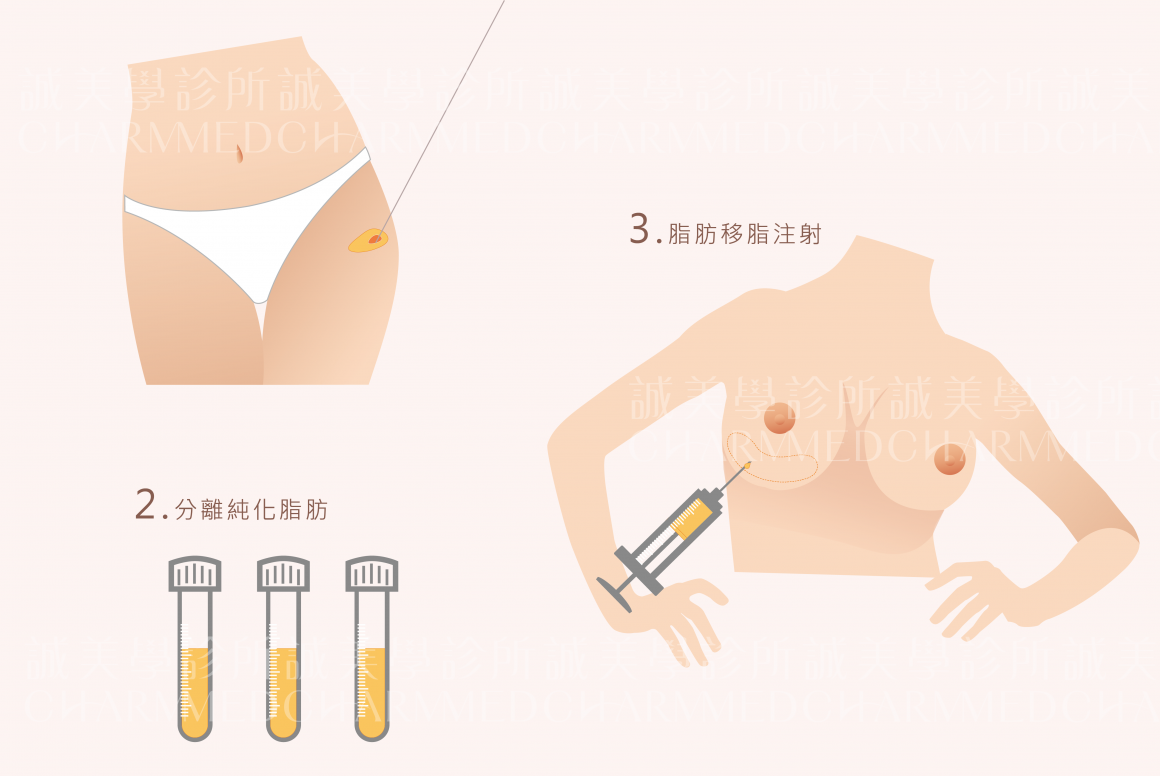 自體脂肪隆乳_工作區域 1 自體脂肪隆乳_工作區域 1
