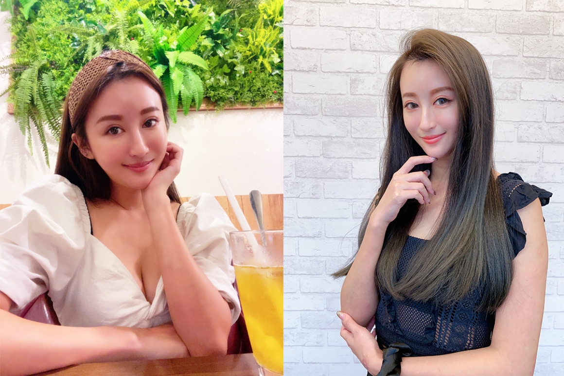玻尿酸-蘋果肌+夫妻宮術後02 玻尿酸-蘋果肌+夫妻宮術後02
