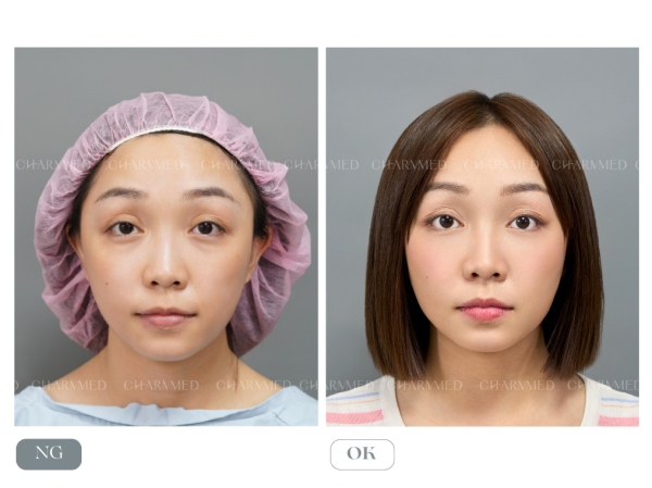 耕式眼袋：眼袋内開 + 自體脂肪補淚溝、蘋果肌、法令紋
