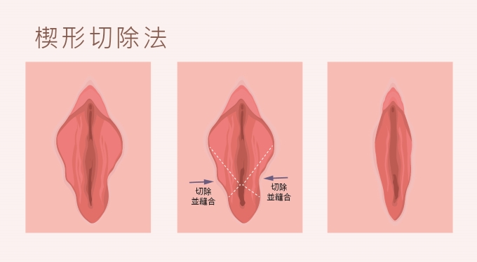 楔形切除法 楔形切除法