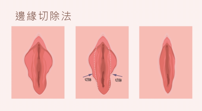 邊緣切除法 邊緣切除法