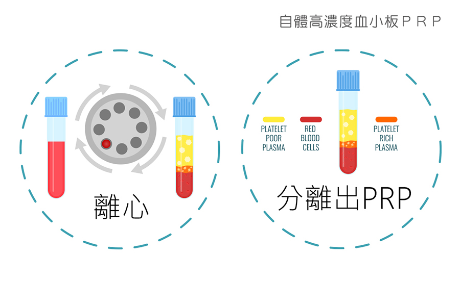 自體高濃度血小板ＰＲＰ