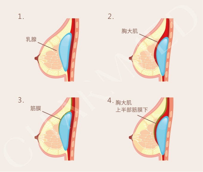 義乳植入位置手術方式