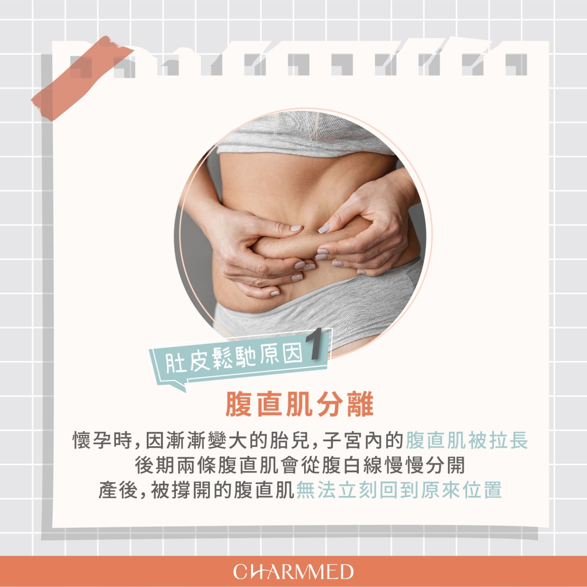 形體雕塑-產後鬆弛拉皮 形體雕塑-產後鬆弛拉皮