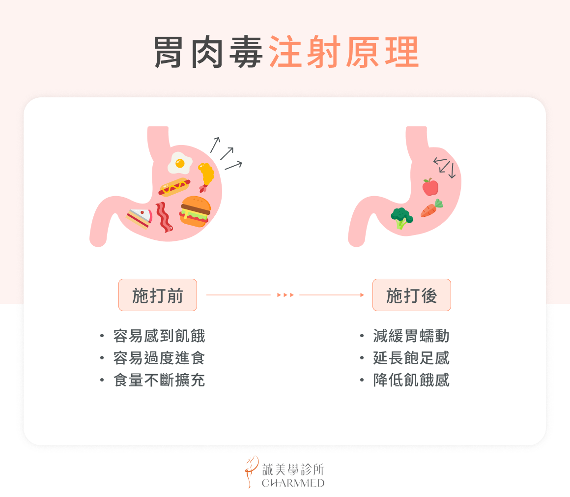 胃肉毒注射原理