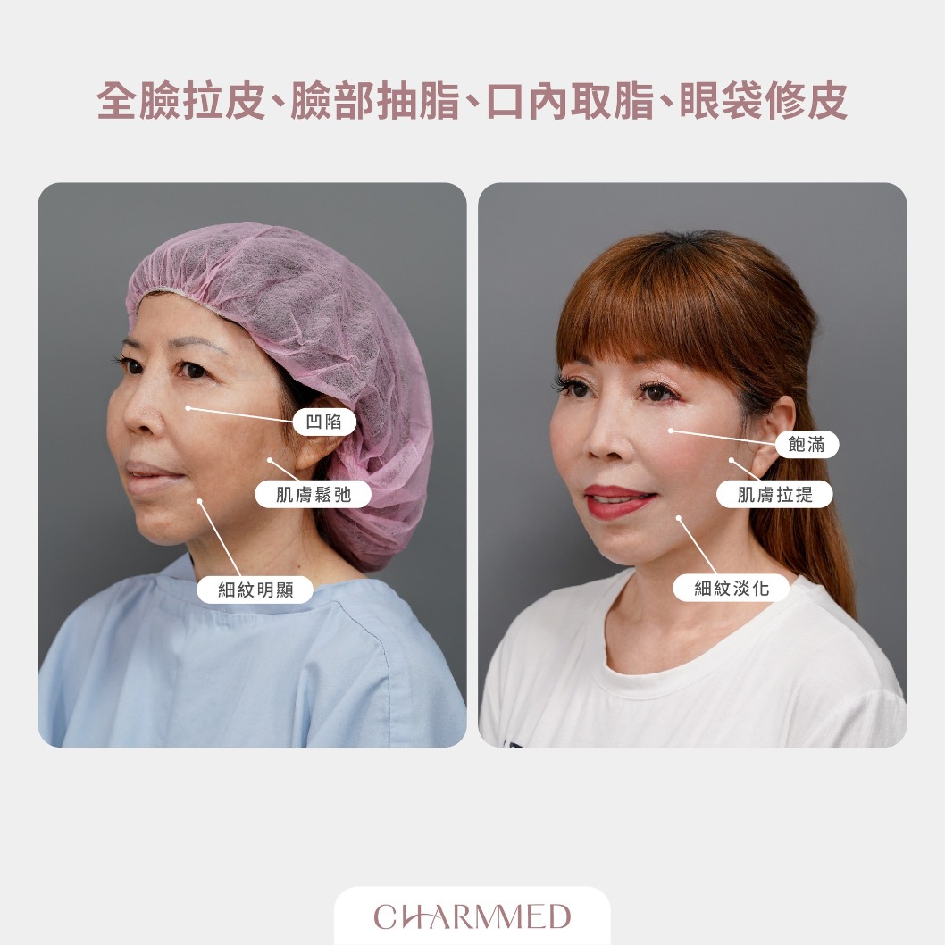 誠美學診所 整形外科林孟羲醫師 複合式臉部拉皮真實案例