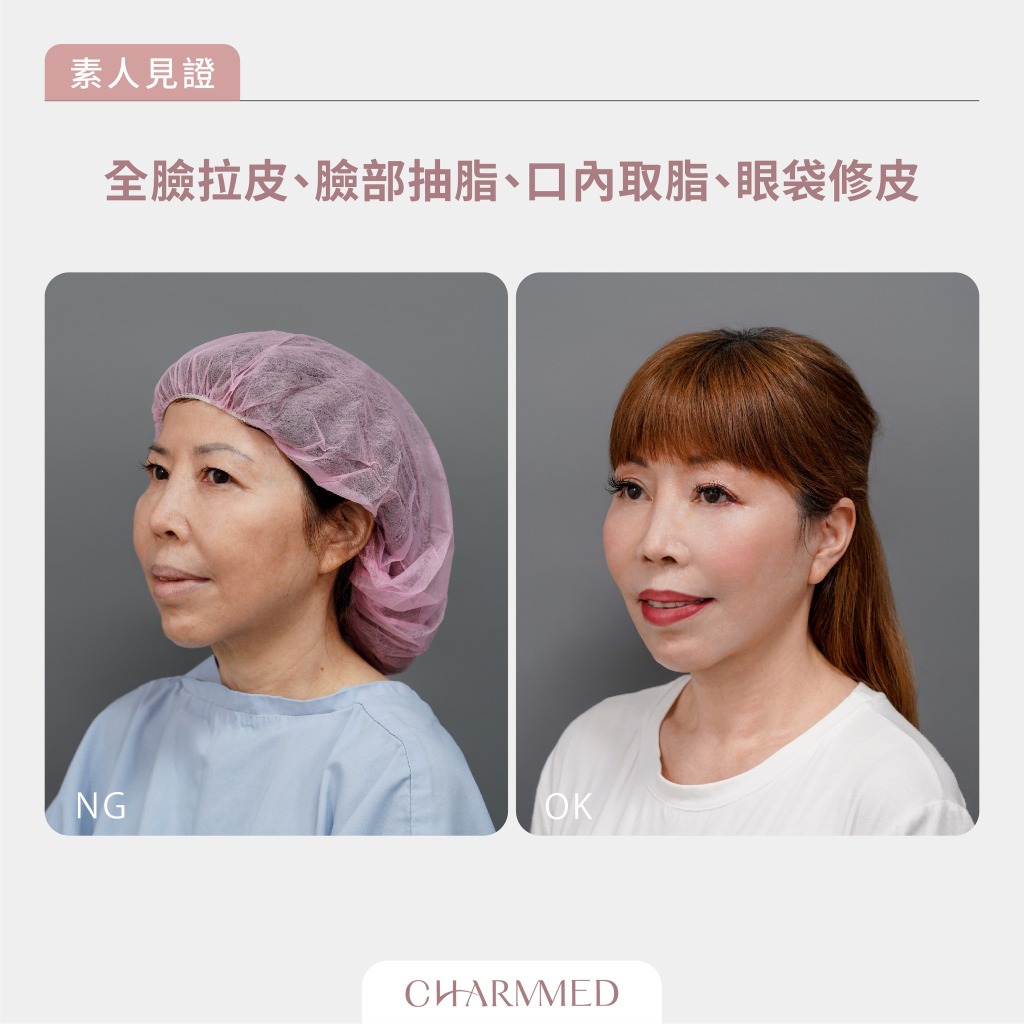 誠美學診所 整形外科林孟羲醫師 複合式臉部拉皮真實案例