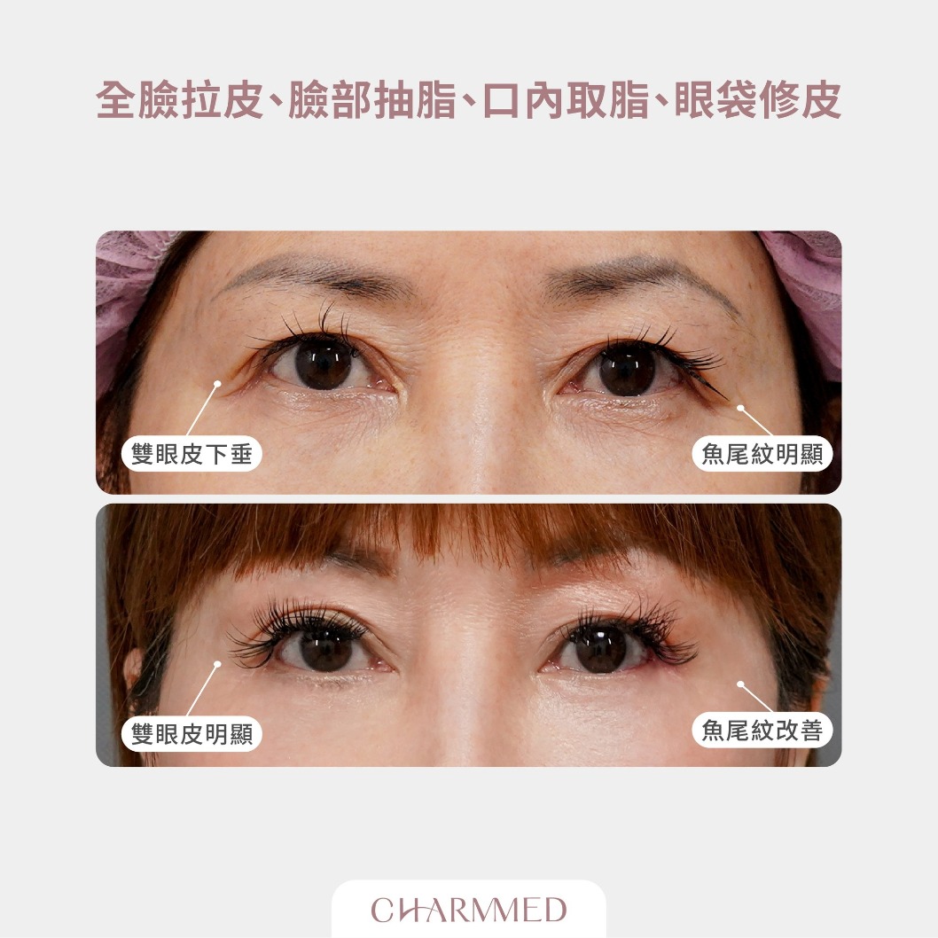 誠美學診所 整形外科林孟羲醫師 複合式臉部拉皮真實案例