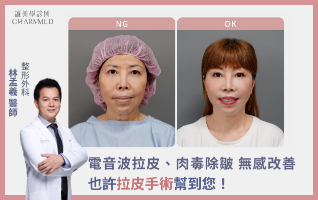 電音波拉皮、肉毒除皺開始無感？也許拉皮手術幫到您！< 林孟羲醫師專欄 >