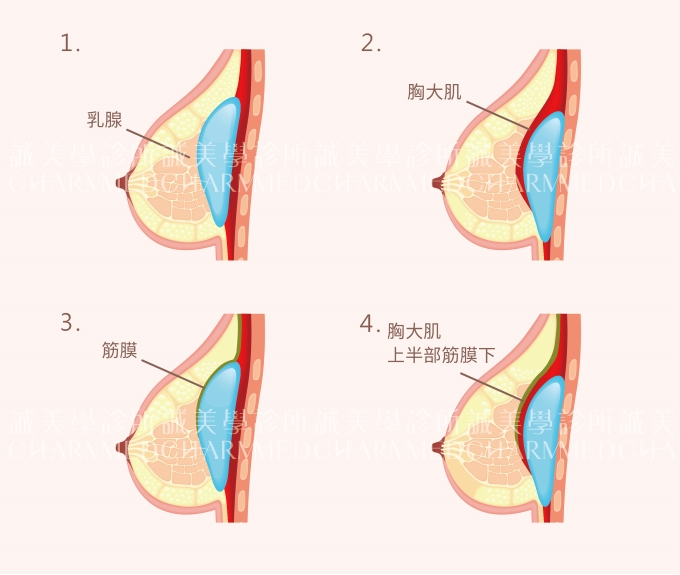 賽彬矽膠充填之乳房植入物(俗稱柔滴)