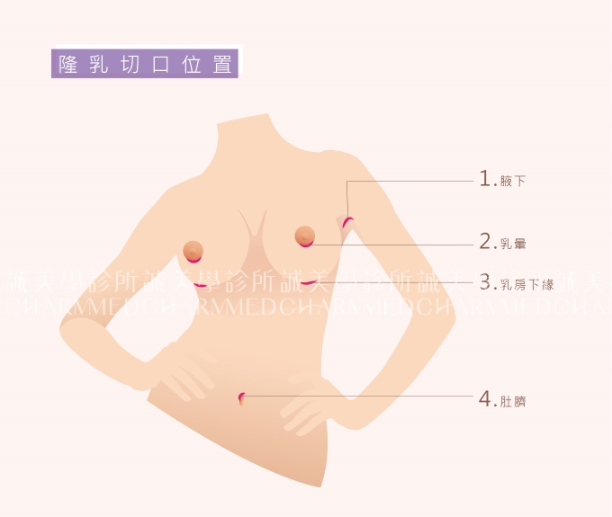 MENTOR曼陀 水滴型矽膠義乳