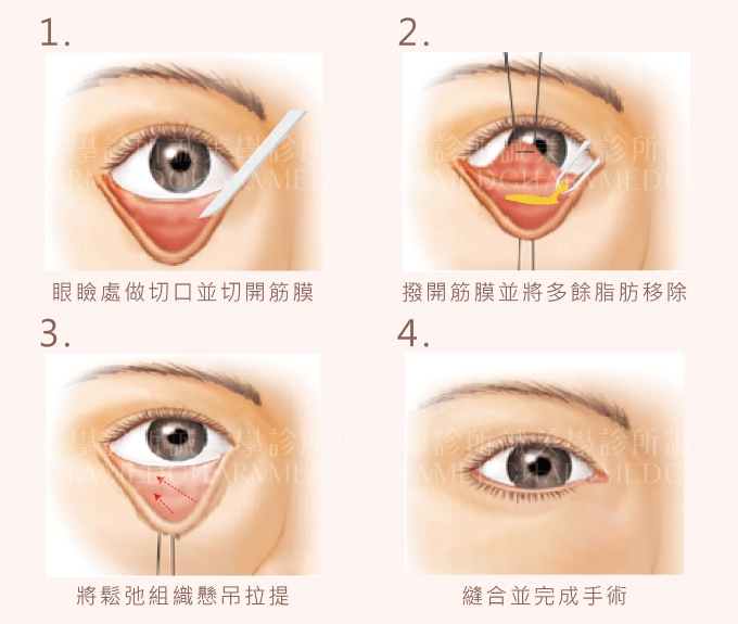 眼袋內開手術方式