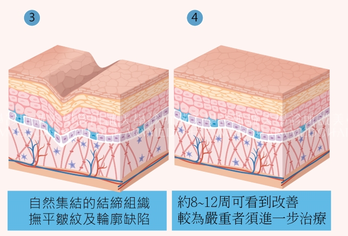 3D聚左旋乳酸（舒顏萃Sculptra）